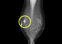 右中部の腫瘤のマンモグラフィ画像