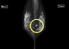 左中部の腫瘤のマンモグラフィ画像