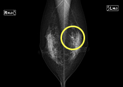 左中部の石灰化のマンモグラフィ画像