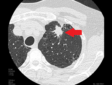 胸部CTの画像1