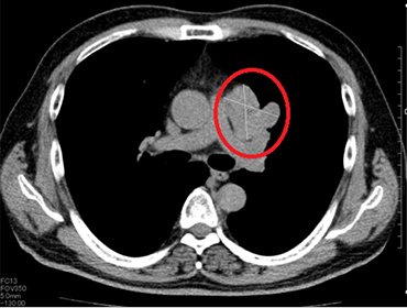 胸部CTの画像2